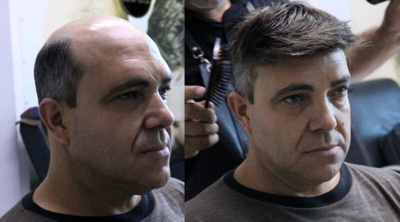 Prótese capilar devolve autoestima a homens que enfrentam a calvície